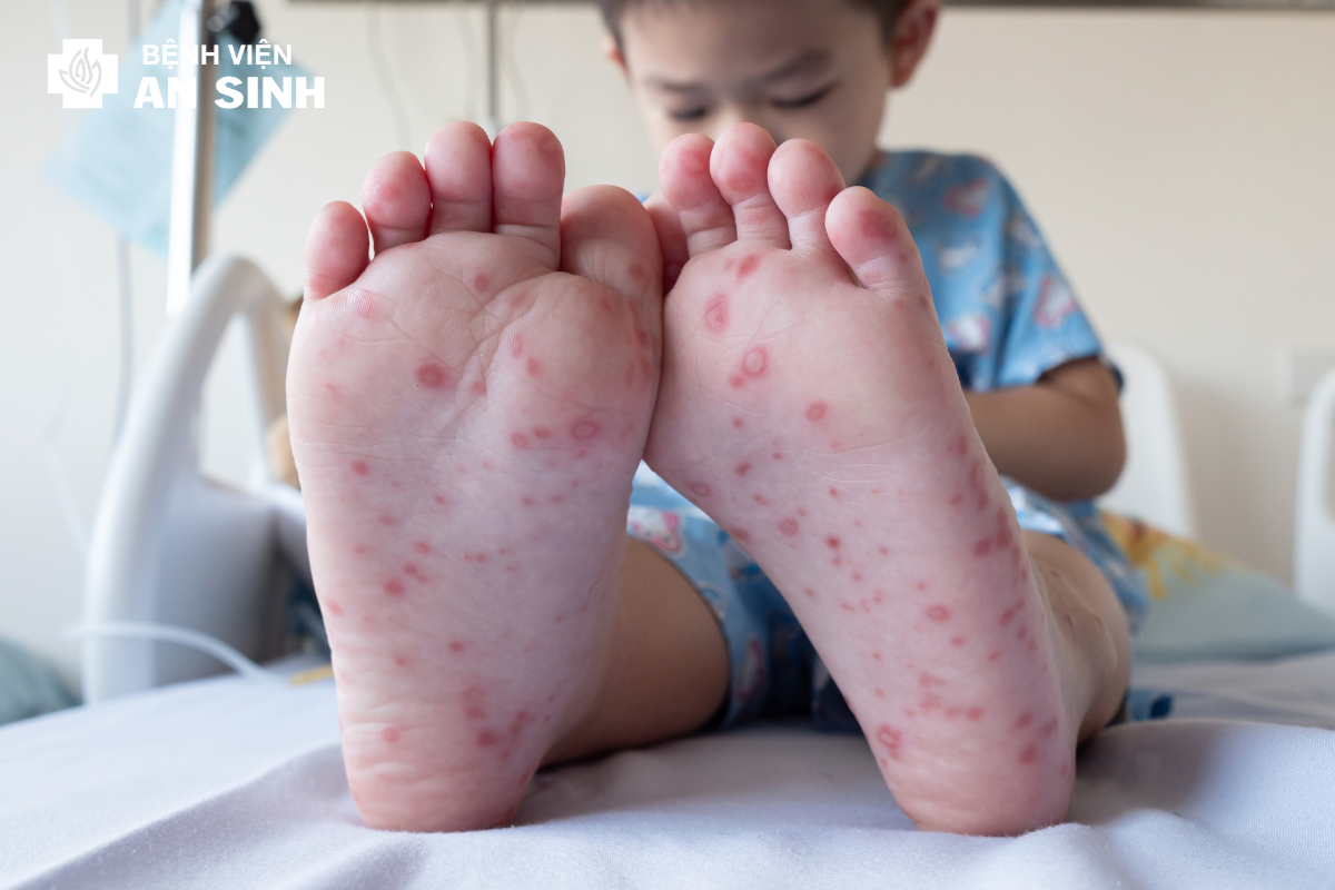 Bệnh tay chân miệng ở trẻ em 1