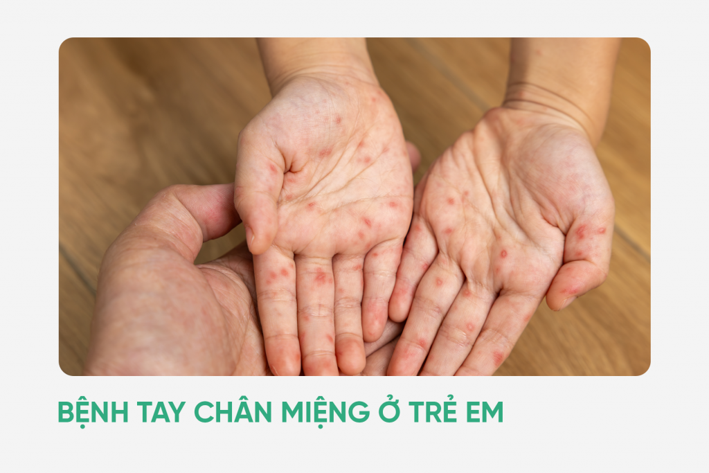 Bệnh tay chân miệng ở trẻ em
