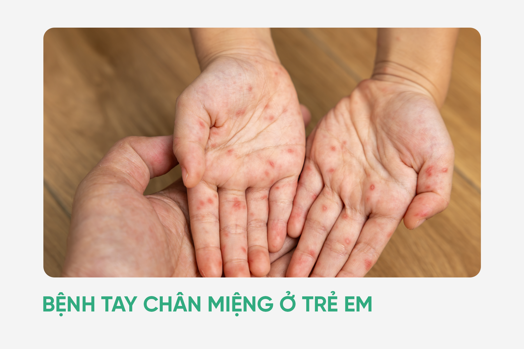 Bệnh tay chân miệng ở trẻ em