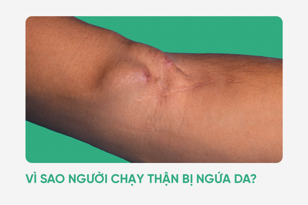 chạy thận bị ngứa